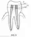 Fig. 04 - Dental implant