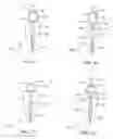 Fig. 02 - Force redirecting dental core system