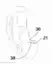 Fig. 01 - Method for Treating Headaches with Intra-Aural Devices