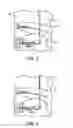 Fig. 02 - Acromioclavicular joint fixation technique