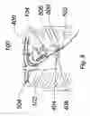 Fig. 07 - Expandable transapical sheath and method of use