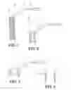 Fig. 02 - EXTRALUMINAL STENT TYPE PROSTHESIS FOR ANASTOMOSIS