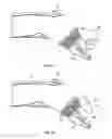 Fig. 21 - Irrigation and aspiration device and method