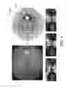 Fig. 06 - GLAUCOMA COMBINATORIAL ANALYSIS