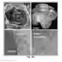 Fig. 24 - Method of treating heart tissue using induced pluripotent stem cells