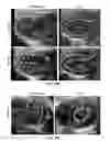 Fig. 28 - Method of treating heart tissue using induced pluripotent stem cells