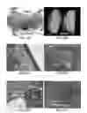 Fig. 41 - Method of treating heart tissue using induced pluripotent stem cells