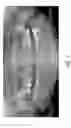 Fig. 02 - Therapeutic tooth bud ablation