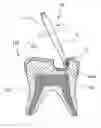 Fig. 01 - STAINLESS STEEL BUR