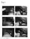 Fig. 07 - Tissue occluding agent comprising an IEIKIEIKIEIKI peptide
