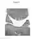 Fig. 09 - METHODS OF TREATING CARTILAGE DEFECTS