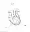 Fig. 19 - Heart help device, system, and method