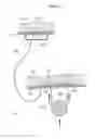 Fig. 03 - Variable sling for urinary continence