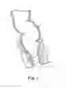 Fig. 04 - Minimally invasive implant and method