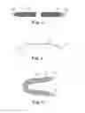 Fig. 05 - Minimally invasive implant and method