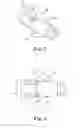 Fig. 06 - Minimally invasive implant and method
