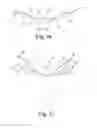 Fig. 09 - Minimally invasive implant and method