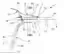 Fig. 01 - Device for surgical operations on a prolapse