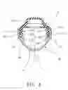 Fig. 04 - Device for surgical operations on a prolapse