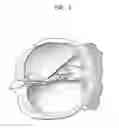 Fig. 02 - Cochlear implant electrode lead having a cross-section with variable height
