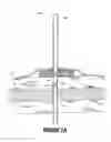 Fig. 08 - External fixation assembly and method of use