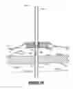 Fig. 09 - External fixation assembly and method of use
