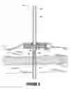 Fig. 10 - External fixation assembly and method of use