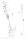 Fig. 07 - Methods and apparatus for treating vertebral fractures