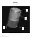 Fig. 05 - APPARATUS FOR DELIVERY OF VISCOUS MATERIAL DURING SURGERY