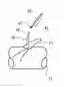 Fig. 01 - Temporary anastomotic seal and method