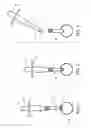 Fig. 02 - Temporary anastomotic seal and method