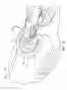 Fig. 22 - Temporary anastomotic seal and method