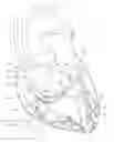 Fig. 01 - Operating a vessel occlusion catheter