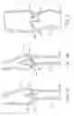 Fig. 02 - Apparatus and methods for creating a venous valve from autologous tissue