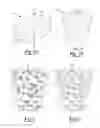 Fig. 02 - Method and apparatus for augmenting bone defects