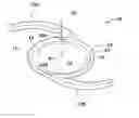 Fig. 01 - Toric optic for ophthalmic use