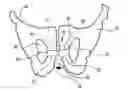 Fig. 01 - IMPLANTABLE URETHRAL PROSTHESIS HAVING TABLE MEMBER