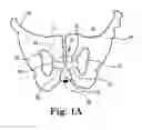 Fig. 02 - IMPLANTABLE URETHRAL PROSTHESIS HAVING TABLE MEMBER