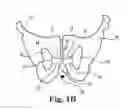 Fig. 03 - IMPLANTABLE URETHRAL PROSTHESIS HAVING TABLE MEMBER