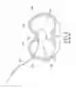Fig. 02 - INTRODUCER DEVICE FOR USE IN NUSS PROCEDURE