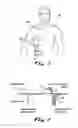 Fig. 02 - TRACHEAL CATHETER AND PROSTHESIS AND METHOD OF RESPIRATORY SUPPORT OF A PATIENT