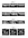 Fig. 02 - METHOD FOR RESTORING MISSING TOOTH AND METHOD FOR PRODUCING RESTORATIVE MATERIAL