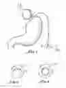 Fig. 02 - Implantable access port device and attachment system