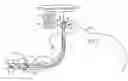 Fig. 01 - SENSOR ON NON-SEALING PORTION OF TRACHEAL TUBE CUFF
