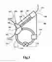 Fig. 02 - METHOD AND APPARATUS FOR THE REMOVAL OF NON DESIRED BIOLOGICAL COMPONENTS FROM SURFACES OF EXTERNAL TISSUES