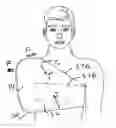 Fig. 01 - Arm sling  for post trauma patients