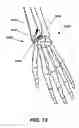 Fig. 15 - Intramedullary fixation screw, a fixation system, and method of fixation of the subtalar joint