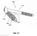 Fig. 19 - Intramedullary fixation screw, a fixation system, and method of fixation of the subtalar joint