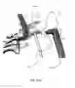Fig. 26 - Intramedullary fixation screw, a fixation system, and method of fixation of the subtalar joint