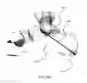 Fig. 27 - Intramedullary fixation screw, a fixation system, and method of fixation of the subtalar joint